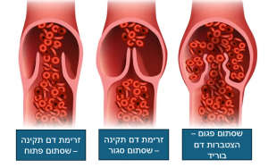 זרימת ורידים - בלוג
