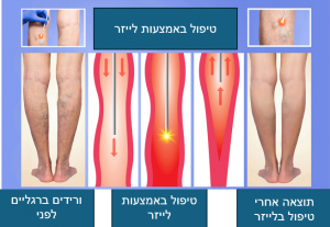 טיפול בלייזר בורידים